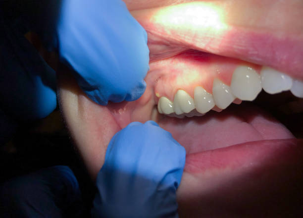 Best Emergency Gum Treatment in Hawaiian Gardens, CA